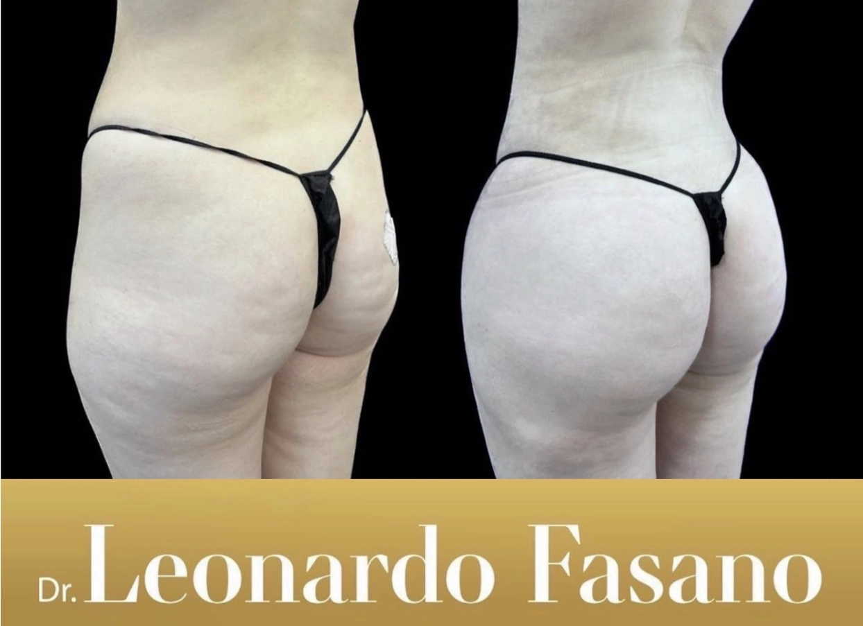 Fat Transfer with Dr Fasano