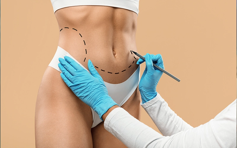 Everything You Need to Know: Vaser Liposuction in London