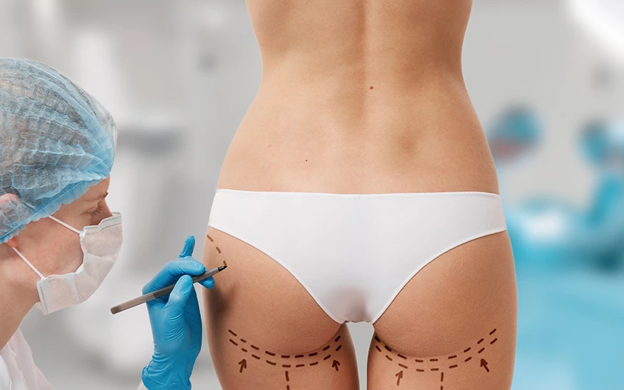 What is Vaser Liposuction?