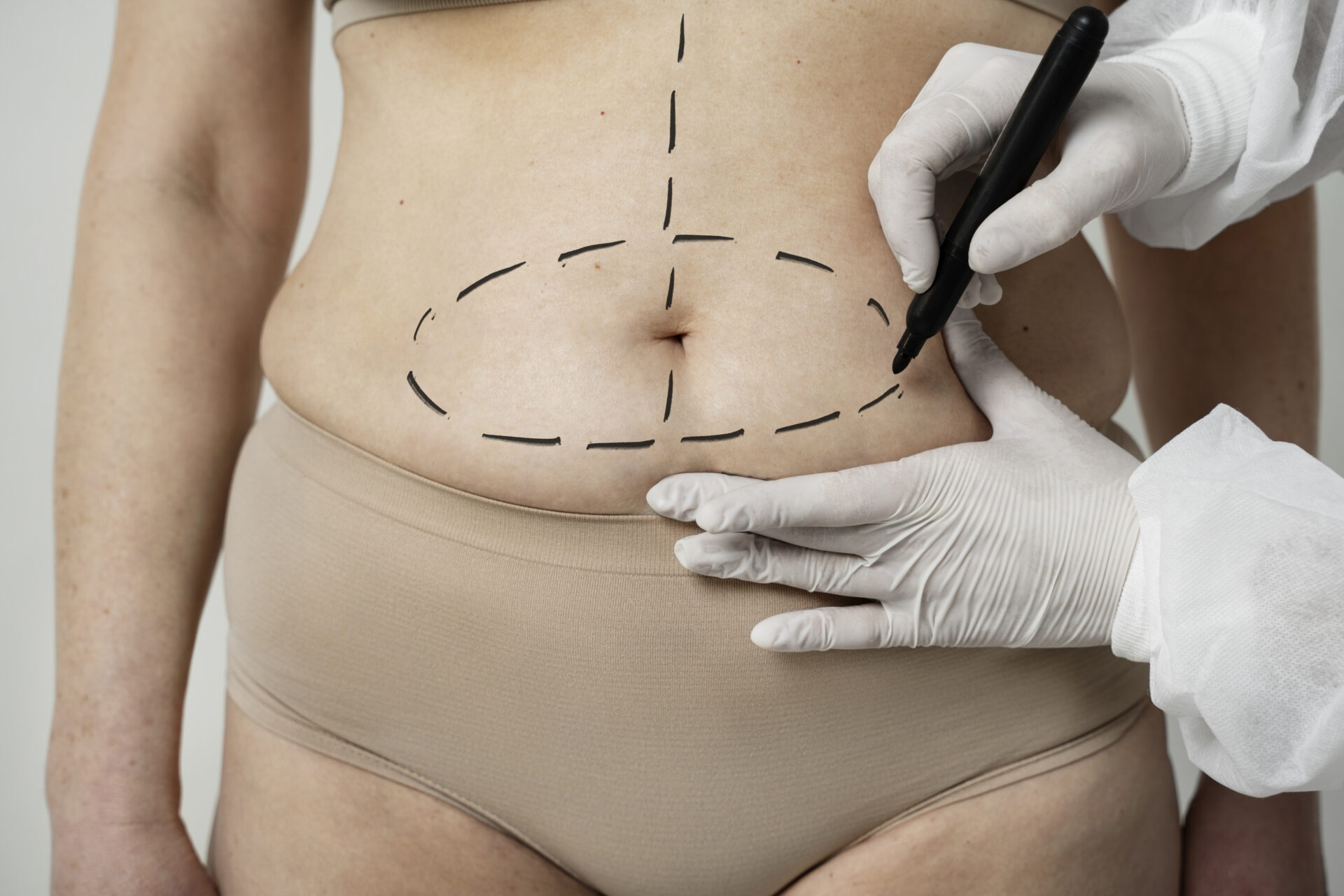 What Is Tummy Tuck Surgery?